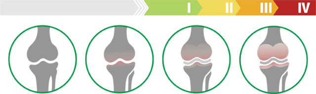 Лечение артроза коленного сустава: консервативные методы и операция